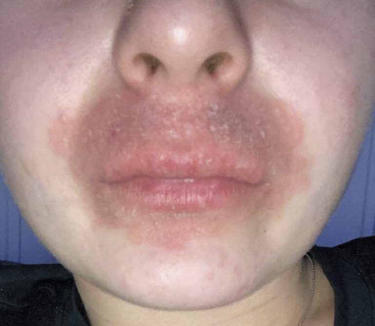 Увеличават се случаите на контактен   дерматит, ринит и бронхиална астма