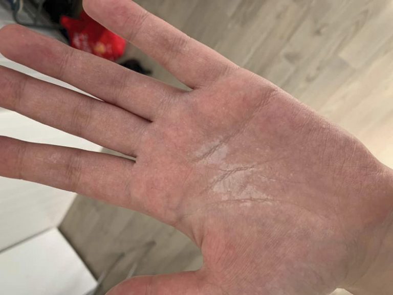 Увеличават се случаите на контактен   дерматит, ринит и бронхиална астма