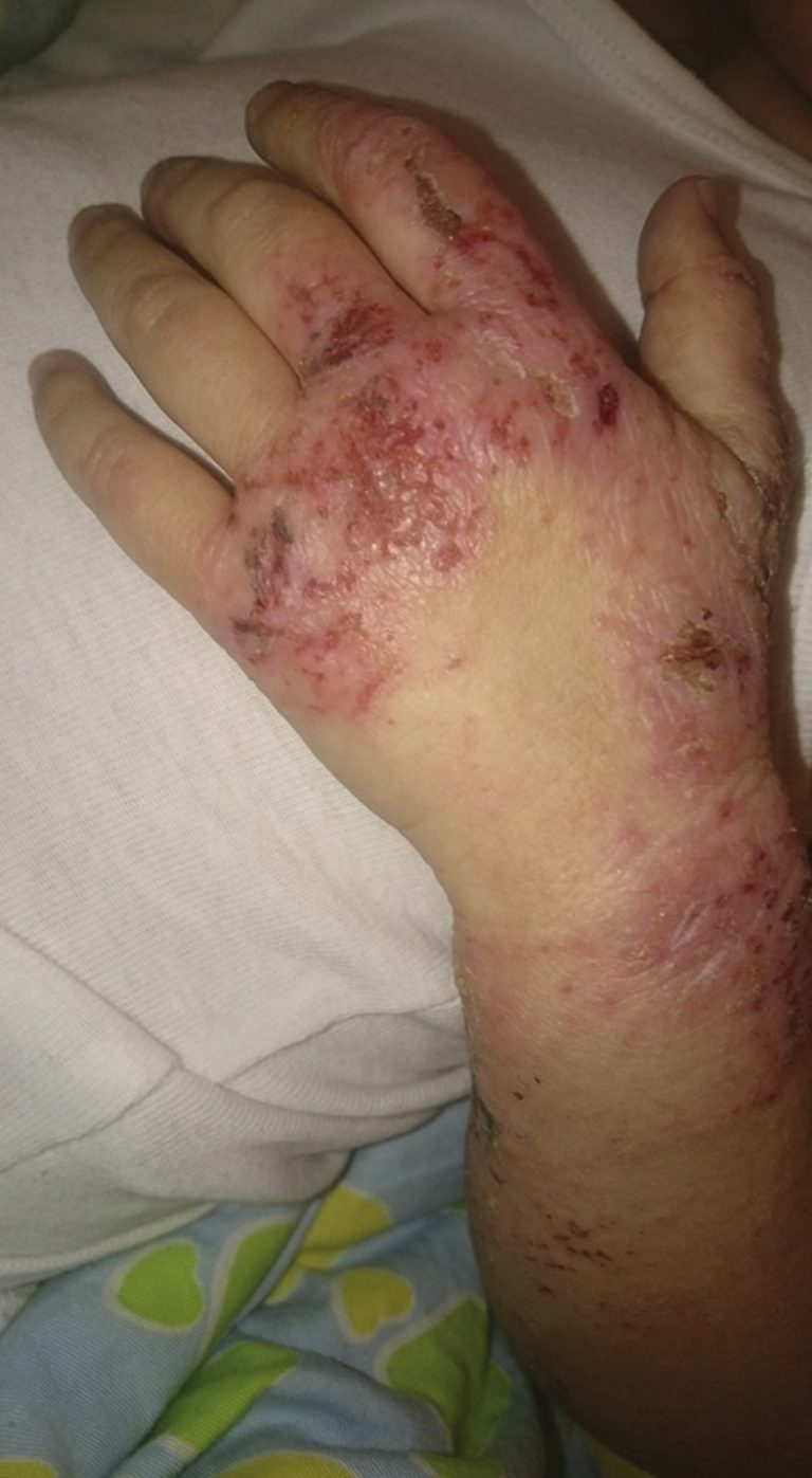 Увеличават се случаите на контактен   дерматит, ринит и бронхиална астма