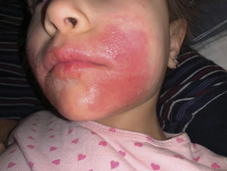 Здраве | Увеличават се случаите на контактен   дерматит, ринит и бронхиална астма